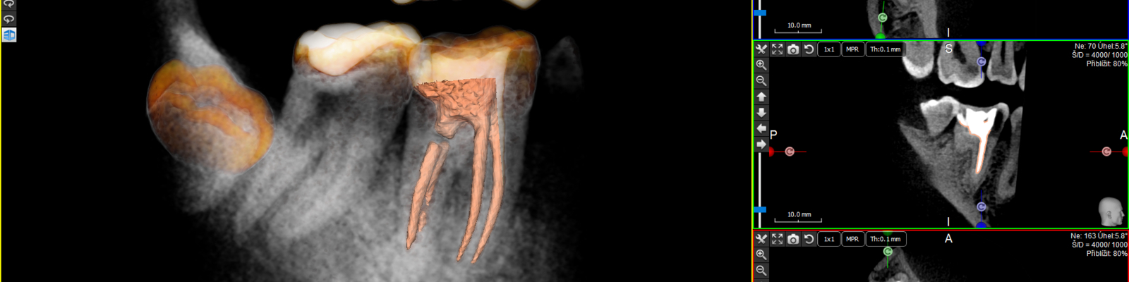 3D CBCT pro endodoncii