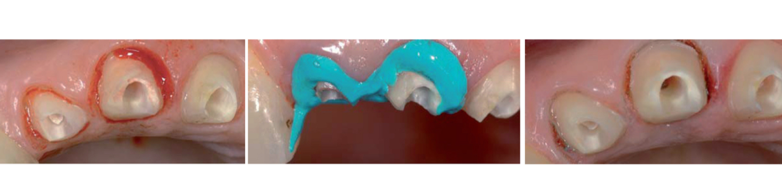 Hemostasyl - zastavení krvácení před otiskem