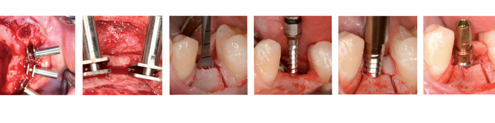 Bone Management BONE SPREADING Rozšíření úzkého alveolu