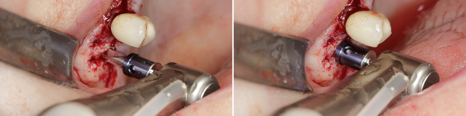 Bone Management Implantologická preparace