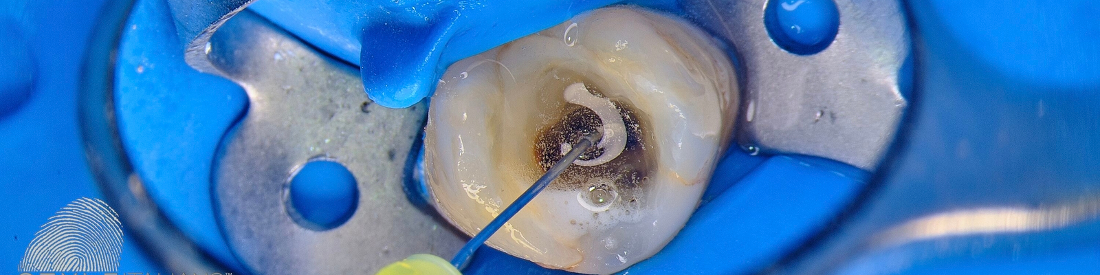 Kanyly a nástroje pro výplach kořenového kanálku 