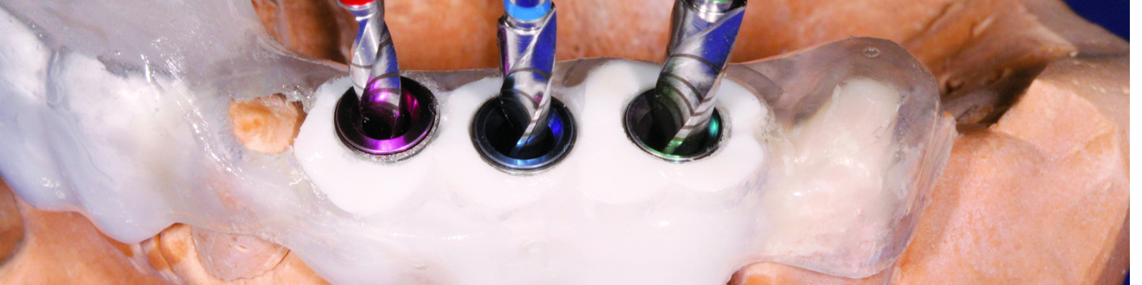 Bone Management Navigovaná implantologie