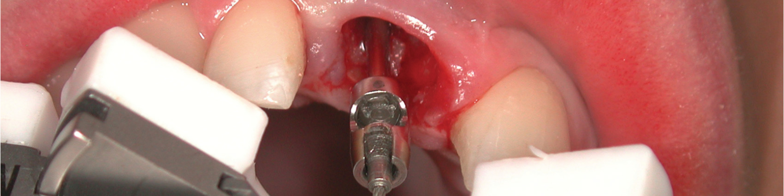Bone Management neinvazivní extrakce kořene zubu