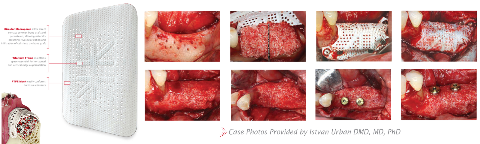 Osteogenics RPM® Ti-250 titanem vyztužená PTFE membrána