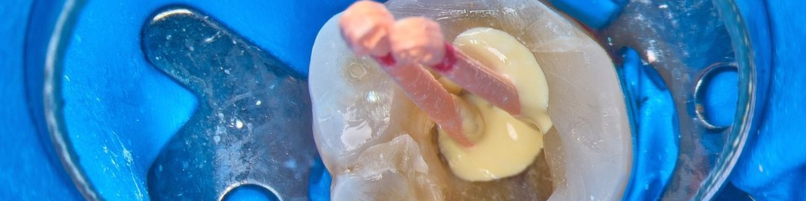 Sealery a endodontické materiály