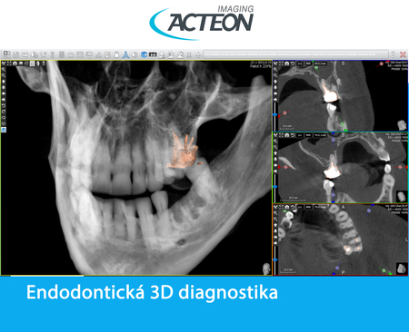 CBCT 3D endodontická diagnostika5